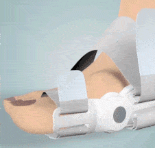 Coeurva Nastavitelný korektor vbočeného palce (Hallux Valgus)